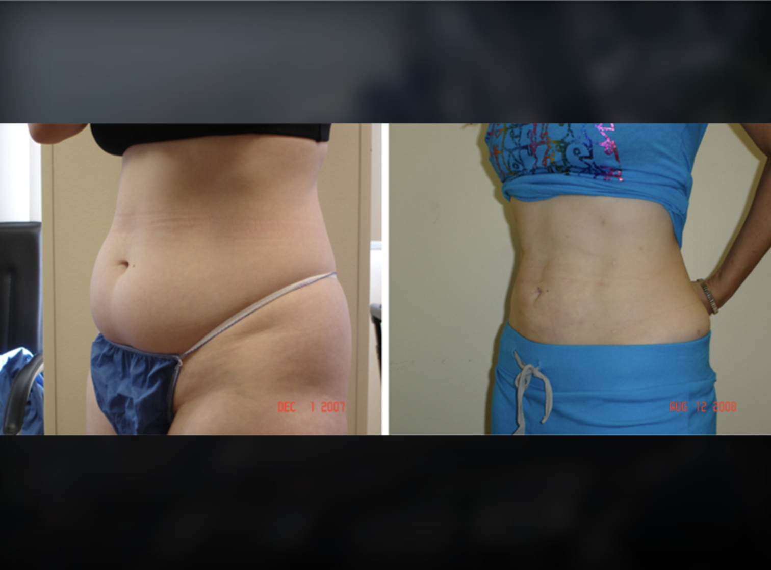 Breast Lift before and after